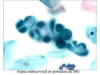 Adenocarcinoma “velloso” de endocérvix