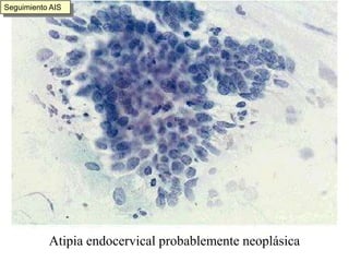 ADENOCA 49 Ca adenoescamoso