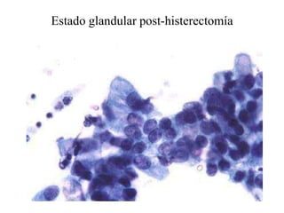 Endocérvix 81 Adenocarcinoma papilar, posiblemente extrauterino (ovárico)