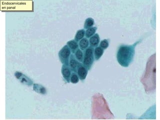 Endocervicales en panal