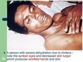  A person with severe dehydration due to cholera -
note the sunken eyes and decreased skin turgor
28 which produces wrinkled hands and skin