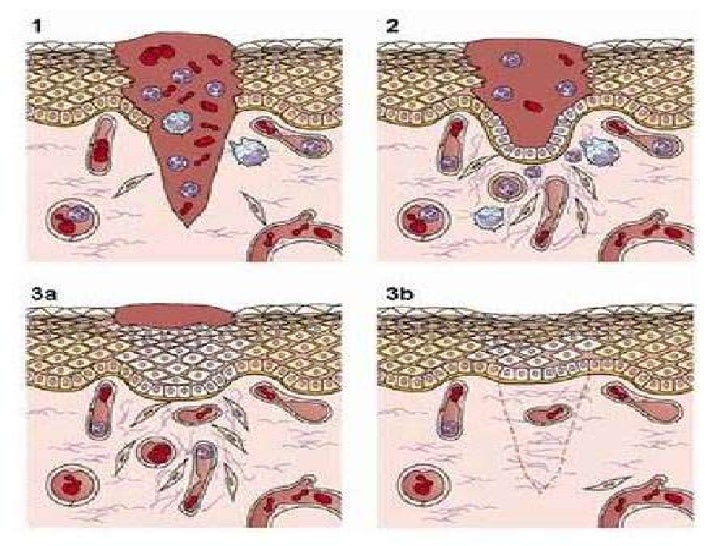 15. cicatrización de las heridas2
