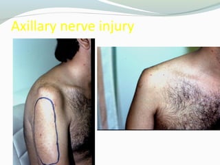 15 common shoulder disorders | PPT