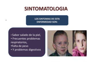 SINTOMATOLOGIA
.                       LOS SINTOMAS DE ESTA
                          ENFERMEDAD SON:




    • Sabor salado de la piel,
    • Frecuentes problemas
    respiratorios,
    •Falta de peso
    • Y problemas digestivos
 
