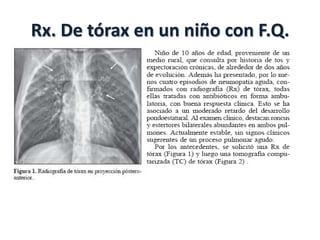 Rx. De tórax en un niño con F.Q.
 