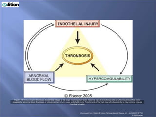 Figure 4-13 Virchow triad in thrombosis. Endothelial integrity is the single most important factor. Note that injury to endothelial cells can affect local blood flow and/or
coagulability; abnormal blood flow (stasis or turbulence) can, in turn, cause endothelial injury. The elements of the triad may act independently or may combine to cause
thrombus formation.
Downloaded from: Robbins & Cotran Pathologic Basis of Disease (on 1 April 2005 07:37 PM)
© 2005 Elsevier
 