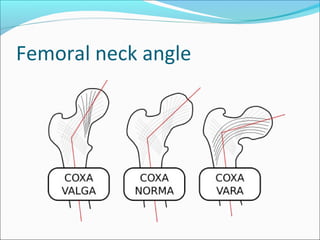 Femoral neck angle

 