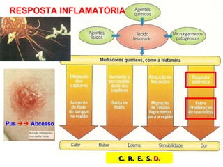 RESPOSTA INFLAMATÓRIA C.  R.  E.  S.  D. Pus     Abcesso 