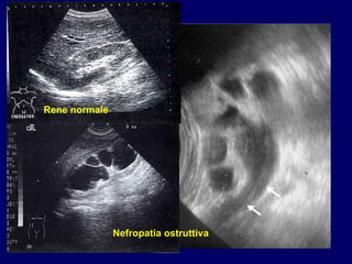 Rene normale Nefropatia ostruttiva 