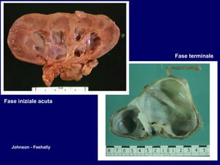 Johnson - Feehally Fase iniziale acuta Fase terminale 