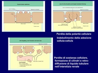 Perdita della polarità cellulare Indebolimento della adesione cellula-cellula  Perdita di sostanza cellulare, formazione di cilindri e retro- diffusione di liquido tubulare nell’interstizio renale 