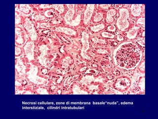 Necrosi cellulare, zone di membrana  basale“nuda”, edema interstiziale,  cilindri intratubulari 
