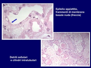 Epitelio appiattito, frammenti di membrana  basale nuda (freccia) Detriti cellulari e cilindri intratubulari 