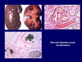 Necrosi tubulare acuta da bilirubina 