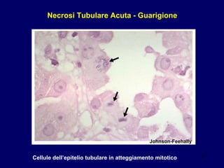 Necrosi Tubulare Acuta - Guarigione Cellule dell’epitelio tubulare in atteggiamento mitotico Johnson-Feehally 