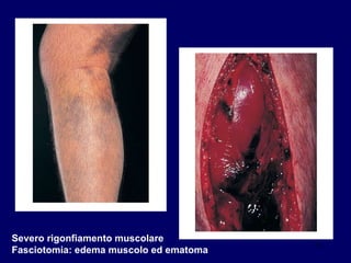 Severo rigonfiamento muscolare Fasciotomia: edema muscolo ed ematoma 