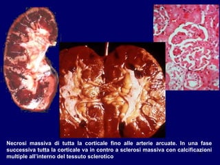 Necrosi massiva di tutta la corticale fino alle arterie arcuate. In una fase successiva tutta la corticale va in contro a sclerosi massiva con calcificazioni multiple all’interno del tessuto sclerotico 