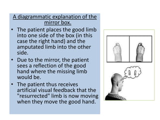 A diagrammatic explanation of the
                 mirror box.
• The patient places the good limb
   into one side of the box (in this
   case the right hand) and the
   amputated limb into the other
   side.
• Due to the mirror, the patient
   sees a reflection of the good
   hand where the missing limb
   would be.
• The patient thus receives
   artificial visual feedback that the
   "resurrected" limb is now moving
   when they move the good hand.
 