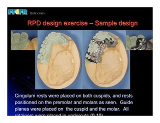 Guide Plane Rpd Sample 15. (new)definitive obturators partially edent patients | PDF