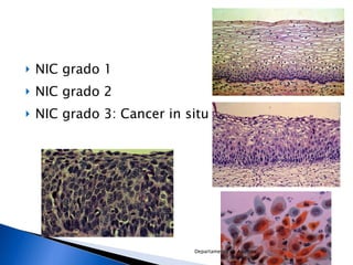 NIC grado 1 NIC grado 2 NIC grado 3: Cancer in situ Departamento de Agentes Biológicos 