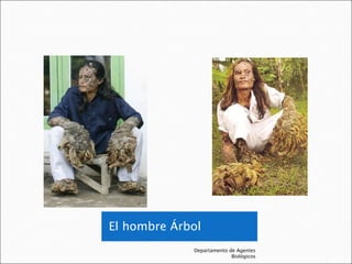El hombre Árbol Departamento de Agentes Biológicos 