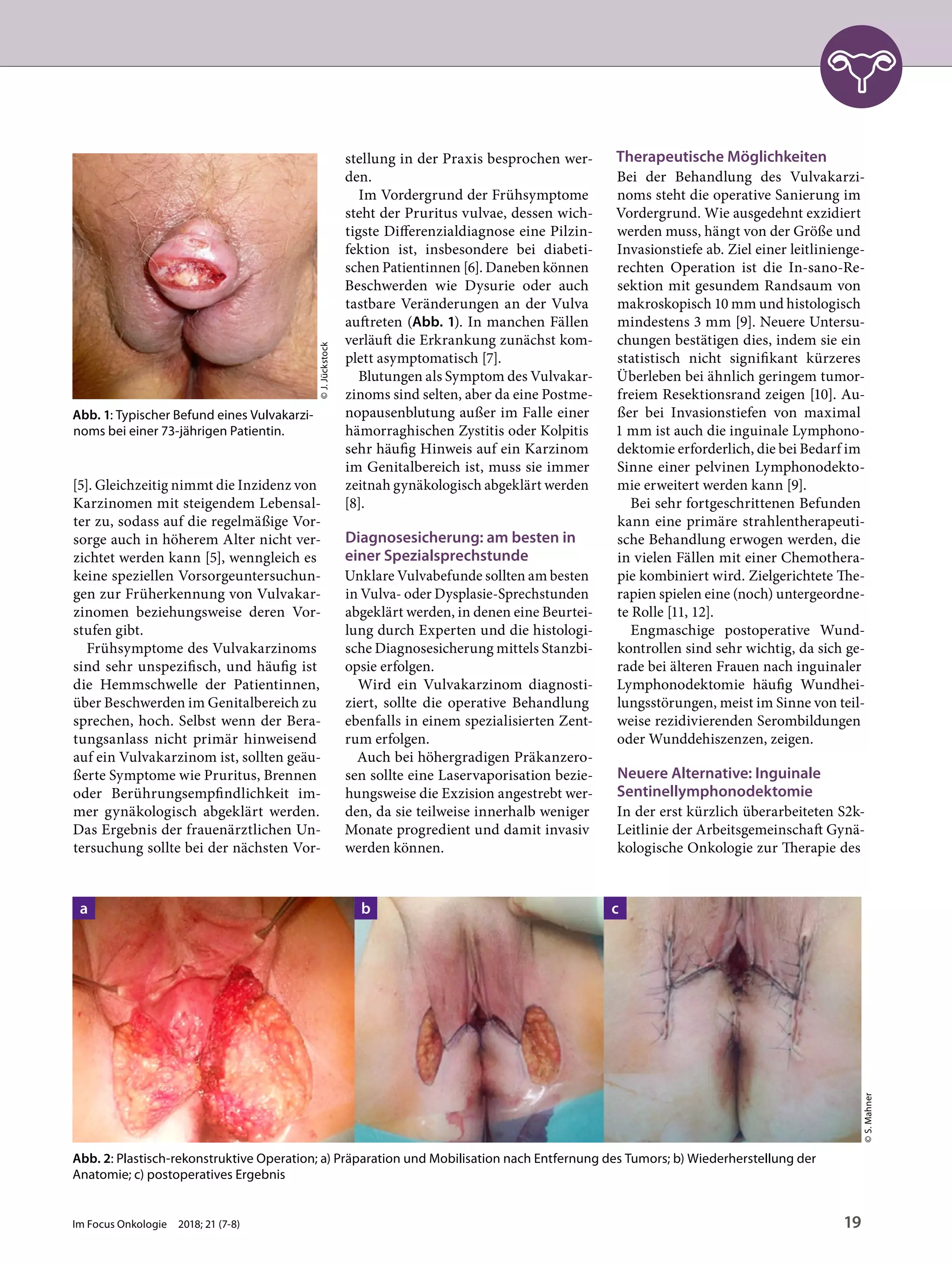 [5]. Gleichzeitig nimmt die Inzidenz von
Karzinomen mit steigendem Lebensal-
ter zu, sodass auf die regelmäßige Vor-
sorge auch in höherem Alter nicht ver-
zichtet werden kann [5], wenngleich es
keine speziellen Vorsorgeuntersuchun-
gen zur Früherkennung von Vulvakar-
zinomen beziehungsweise deren Vor-
stufen gibt.
Frühsymptome des Vulvakarzinoms
sind sehr unspezifisch, und häufig ist
die Hemmschwelle der Patientinnen,
über Beschwerden im Genitalbereich zu
sprechen, hoch. Selbst wenn der Bera-
tungsanlass nicht primär hinweisend
auf ein Vulvakarzinom ist, sollten geäu-
ßerte Symptome wie Pruritus, Brennen
oder Berührungsempfindlichkeit im-
mer gynäkologisch abgeklärt werden.
Das Ergebnis der frauenärztlichen Un-
tersuchung sollte bei der nächsten Vor-
stellung in der Praxis besprochen wer-
den.
Im Vordergrund der Frühsymptome
steht der Pruritus vulvae, dessen wich-
tigste Differenzialdiagnose eine Pilzin-
fektion ist, insbesondere bei diabeti-
schen Patientinnen [6]. Daneben können
Beschwerden wie Dysurie oder auch
tastbare Veränderungen an der Vulva
auftreten (Abb. 1). In manchen Fällen
verläuft die Erkrankung zunächst kom-
plett asymptomatisch [7].
Blutungen als Symptom des Vulvakar-
zinoms sind selten, aber da eine Postme-
nopausenblutung außer im Falle einer
hämorraghischen Zystitis oder Kolpitis
sehr häufig Hinweis auf ein Karzinom
im Genitalbereich ist, muss sie immer
zeitnah gynäkologisch abgeklärt werden
[8].
Diagnosesicherung: am besten in
einer Spezialsprechstunde
Unklare Vulvabefunde sollten am besten
in Vulva- oder Dysplasie-Sprechstunden
abgeklärt werden, in denen eine Beurtei-
lung durch Experten und die histologi-
sche Diagnosesicherung mittels Stanzbi-
opsie erfolgen.
Wird ein Vulvakarzinom diagnosti-
ziert, sollte die operative Behandlung
ebenfalls in einem spezialisierten Zent-
rum erfolgen.
Auch bei höhergradigen Präkanzero-
sen sollte eine Laservaporisation bezie-
hungsweise die Exzision angestrebt wer-
den, da sie teilweise innerhalb weniger
Monate progredient und damit invasiv
werden können.
Therapeutische Möglichkeiten
Bei der Behandlung des Vulvakarzi-
noms steht die operative Sanierung im
Vordergrund. Wie ausgedehnt exzidiert
werden muss, hängt von der Größe und
Invasionstiefe ab. Ziel einer leitlinienge-
rechten Operation ist die In-sano-Re-
sektion mit gesundem Randsaum von
makroskopisch 10 mm und histologisch
mindestens 3 mm [9]. Neuere Untersu-
chungen bestätigen dies, indem sie ein
statistisch nicht signifikant kürzeres
Überleben bei ähnlich geringem tumor-
freiem Resektionsrand zeigen [10]. Au-
ßer bei Invasionstiefen von maximal
1 mm ist auch die inguinale Lymphono-
dektomie erforderlich, die bei Bedarf im
Sinne einer pelvinen Lymphonodekto-
mie erweitert werden kann [9].
Bei sehr fortgeschrittenen Befunden
kann eine primäre strahlentherapeuti-
sche Behandlung erwogen werden, die
in vielen Fällen mit einer Chemothera-
pie kombiniert wird. Zielgerichtete The-
rapien spielen eine (noch) untergeordne-
te Rolle [11, 12].
Engmaschige postoperative Wund-
kontrollen sind sehr wichtig, da sich ge-
rade bei älteren Frauen nach inguinaler
Lymphonodektomie häufig Wundhei-
lungsstörungen, meist im Sinne von teil-
weise rezidivierenden Serombildungen
oder Wunddehiszenzen, zeigen.
Neuere Alternative: Inguinale
Sentinellymphonodektomie
In der erst kürzlich überarbeiteten S2k-
Leitlinie der Arbeitsgemeinschaft Gynä-
kologische Onkologie zur Therapie des
Abb. 1: Typischer Befund eines Vulvakarzi-
noms bei einer 73-jährigen Patientin.
©J.Jückstock
Abb. 2: Plastisch-rekonstruktive Operation; a) Präparation und Mobilisation nach Entfernung des Tumors; b) Wiederherstellung der
Anatomie; c) postoperatives Ergebnis
©S.Mahner
a b c
Im Focus Onkologie 2018; 21 (7-8) 19
 