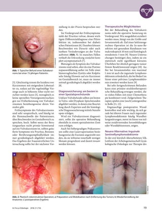 [5]. Gleichzeitig nimmt die Inzidenz von
Karzinomen mit steigendem Lebensal-
ter zu, sodass auf die regelmäßige Vor-
sorge auch in höherem Alter nicht ver-
zichtet werden kann [5], wenngleich es
keine speziellen Vorsorgeuntersuchun-
gen zur Früherkennung von Vulvakar-
zinomen beziehungsweise deren Vor-
stufen gibt.
Frühsymptome des Vulvakarzinoms
sind sehr unspezifisch, und häufig ist
die Hemmschwelle der Patientinnen,
über Beschwerden im Genitalbereich zu
sprechen, hoch. Selbst wenn der Bera-
tungsanlass nicht primär hinweisend
auf ein Vulvakarzinom ist, sollten geäu-
ßerte Symptome wie Pruritus, Brennen
oder Berührungsempfindlichkeit im-
mer gynäkologisch abgeklärt werden.
Das Ergebnis der frauenärztlichen Un-
tersuchung sollte bei der nächsten Vor-
stellung in der Praxis besprochen wer-
den.
Im Vordergrund der Frühsymptome
steht der Pruritus vulvae, dessen wich-
tigste Differenzialdiagnose eine Pilzin-
fektion ist, insbesondere bei diabeti-
schen Patientinnen [6]. Daneben können
Beschwerden wie Dysurie oder auch
tastbare Veränderungen an der Vulva
auftreten (Abb. 1). In manchen Fällen
verläuft die Erkrankung zunächst kom-
plett asymptomatisch [7].
Blutungen als Symptom des Vulvakar-
zinoms sind selten, aber da eine Postme-
nopausenblutung außer im Falle einer
hämorraghischen Zystitis oder Kolpitis
sehr häufig Hinweis auf ein Karzinom
im Genitalbereich ist, muss sie immer
zeitnah gynäkologisch abgeklärt werden
[8].
Diagnosesicherung: am besten in
einer Spezialsprechstunde
Unklare Vulvabefunde sollten am besten
in Vulva- oder Dysplasie-Sprechstunden
abgeklärt werden, in denen eine Beurtei-
lung durch Experten und die histologi-
sche Diagnosesicherung mittels Stanzbi-
opsie erfolgen.
Wird ein Vulvakarzinom diagnosti-
ziert, sollte die operative Behandlung
ebenfalls in einem spezialisierten Zent-
rum erfolgen.
Auch bei höhergradigen Präkanzero-
sen sollte eine Laservaporisation bezie-
hungsweise die Exzision angestrebt wer-
den, da sie teilweise innerhalb weniger
Monate progredient und damit invasiv
werden können.
Therapeutische Möglichkeiten
Bei der Behandlung des Vulvakarzi-
noms steht die operative Sanierung im
Vordergrund. Wie ausgedehnt exzidiert
werden muss, hängt von der Größe und
Invasionstiefe ab. Ziel einer leitlinienge-
rechten Operation ist die In-sano-Re-
sektion mit gesundem Randsaum von
makroskopisch 10 mm und histologisch
mindestens 3 mm [9]. Neuere Untersu-
chungen bestätigen dies, indem sie ein
statistisch nicht signifikant kürzeres
Überleben bei ähnlich geringem tumor-
freiem Resektionsrand zeigen [10]. Au-
ßer bei Invasionstiefen von maximal
1 mm ist auch die inguinale Lymphono-
dektomie erforderlich, die bei Bedarf im
Sinne einer pelvinen Lymphonodekto-
mie erweitert werden kann [9].
Bei sehr fortgeschrittenen Befunden
kann eine primäre strahlentherapeuti-
sche Behandlung erwogen werden, die
in vielen Fällen mit einer Chemothera-
pie kombiniert wird. Zielgerichtete The-
rapien spielen eine (noch) untergeordne-
te Rolle [11, 12].
Engmaschige postoperative Wund-
kontrollen sind sehr wichtig, da sich ge-
rade bei älteren Frauen nach inguinaler
Lymphonodektomie häufig Wundhei-
lungsstörungen, meist im Sinne von teil-
weise rezidivierenden Serombildungen
oder Wunddehiszenzen, zeigen.
Neuere Alternative: Inguinale
Sentinellymphonodektomie
In der erst kürzlich überarbeiteten S2k-
Leitlinie der Arbeitsgemeinschaft Gynä-
kologische Onkologie zur Therapie des
Abb. 1: Typischer Befund eines Vulvakarzi-
noms bei einer 73-jährigen Patientin.
©J.Jückstock
Abb. 2: Plastisch-rekonstruktive Operation; a) Präparation und Mobilisation nach Entfernung des Tumors; b) Wiederherstellung der
Anatomie; c) postoperatives Ergebnis
©S.Mahner
a b c
Im Focus Onkologie 2018; 21 (7-8) 19
 