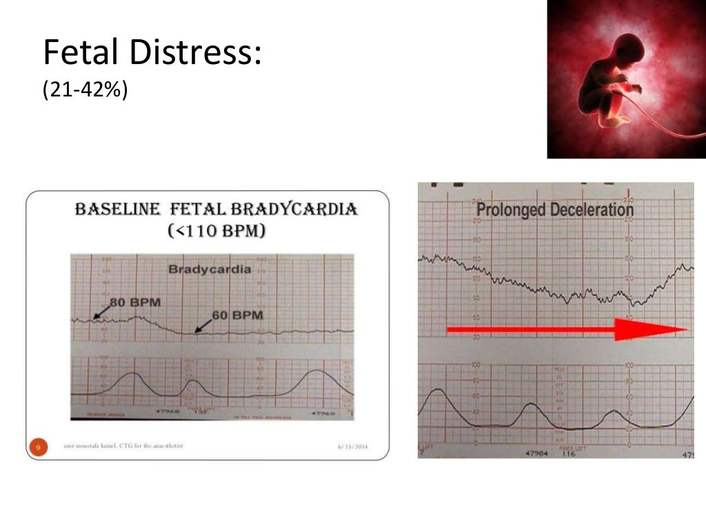 cholestasis of pregnancy/ obstetric cholestasis