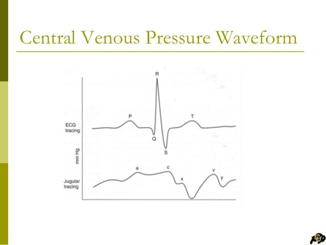 Central Venous Pressure Waveform – UUMK