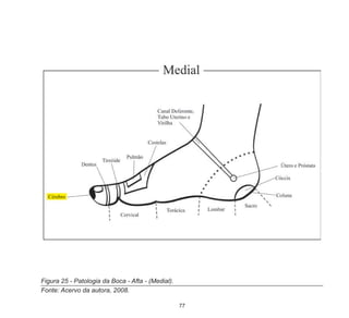 77
Figura 25 - Patologia da Boca - Afta - (Medial).
Fonte: Acervo da autora, 2008.
 