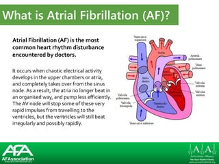 www.afa-international.org www.aa-international.orgwww.afa-international.org www.aa-international.org
Atrial Fibrillation (AF) is the most
common heart rhythm disturbance
encountered by doctors.
It occurs when chaotic electrical activity
develops in the upper chambers or atria,
and completely takes over from the sinus
node. As a result, the atria no longer beat in
an organised way, and pump less efficiently.
The AV node will stop some of these very
rapid impulses from travelling to the
ventricles, but the ventricles will still beat
irregularly and possibly rapidly.
www.afa-international.org www.aa-international.org
What is Atrial Fibrillation (AF)?
 