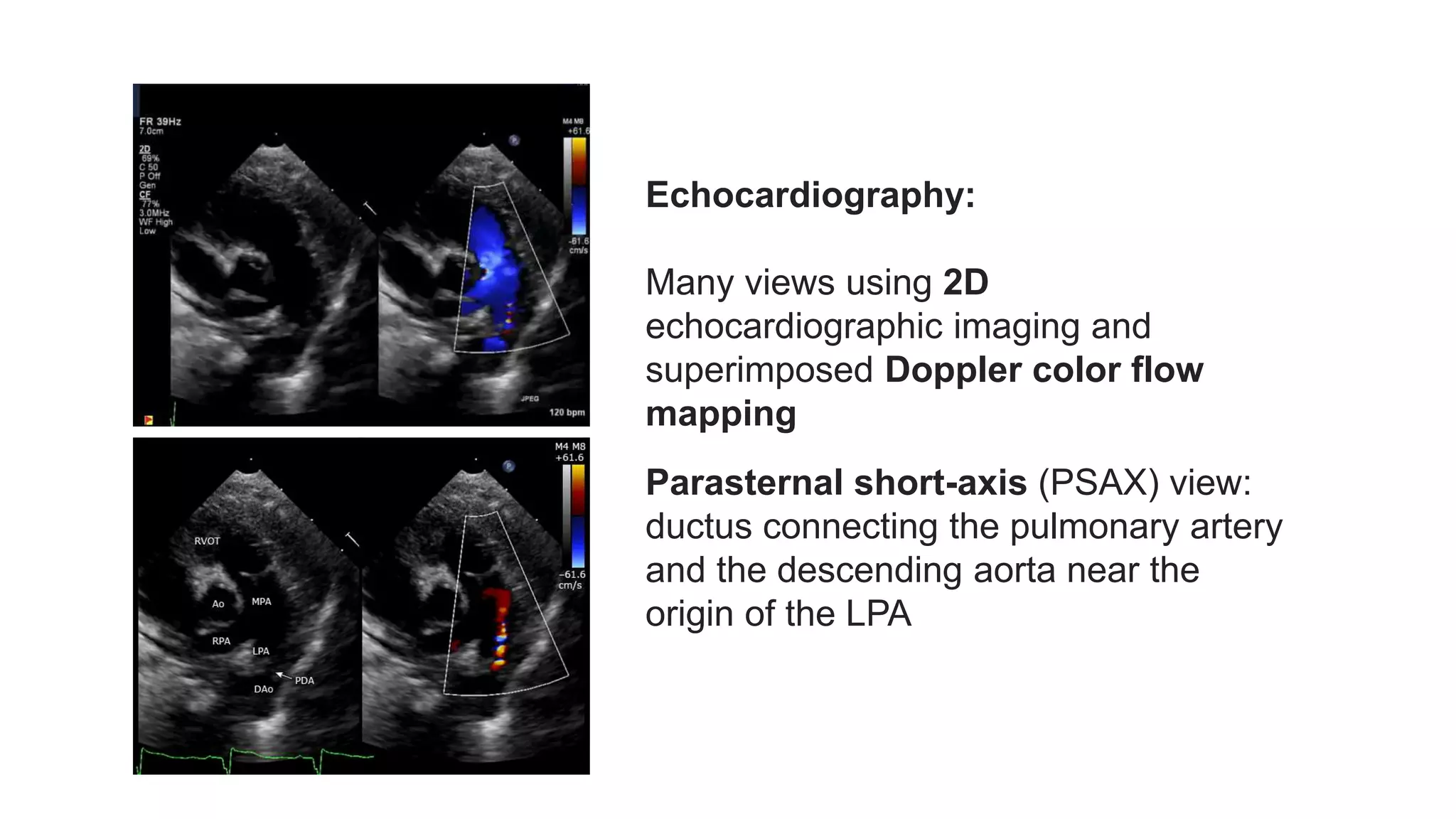 Patent Ductus Arteriosus (PDA) Echocardiographic Assessment Anatomy