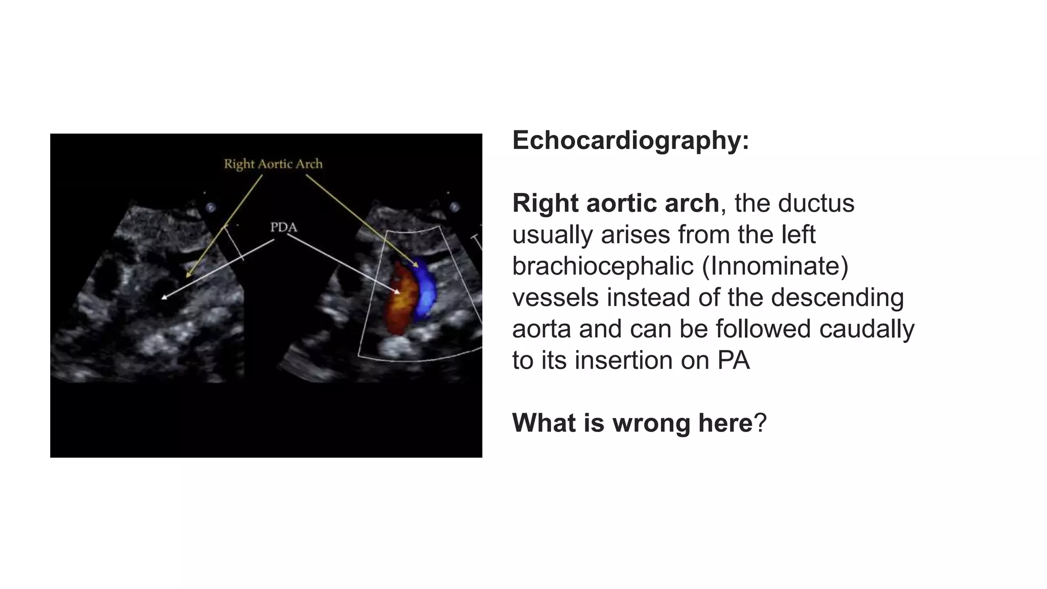 Patent Ductus Arteriosus (PDA) Echocardiographic Assessment Anatomy