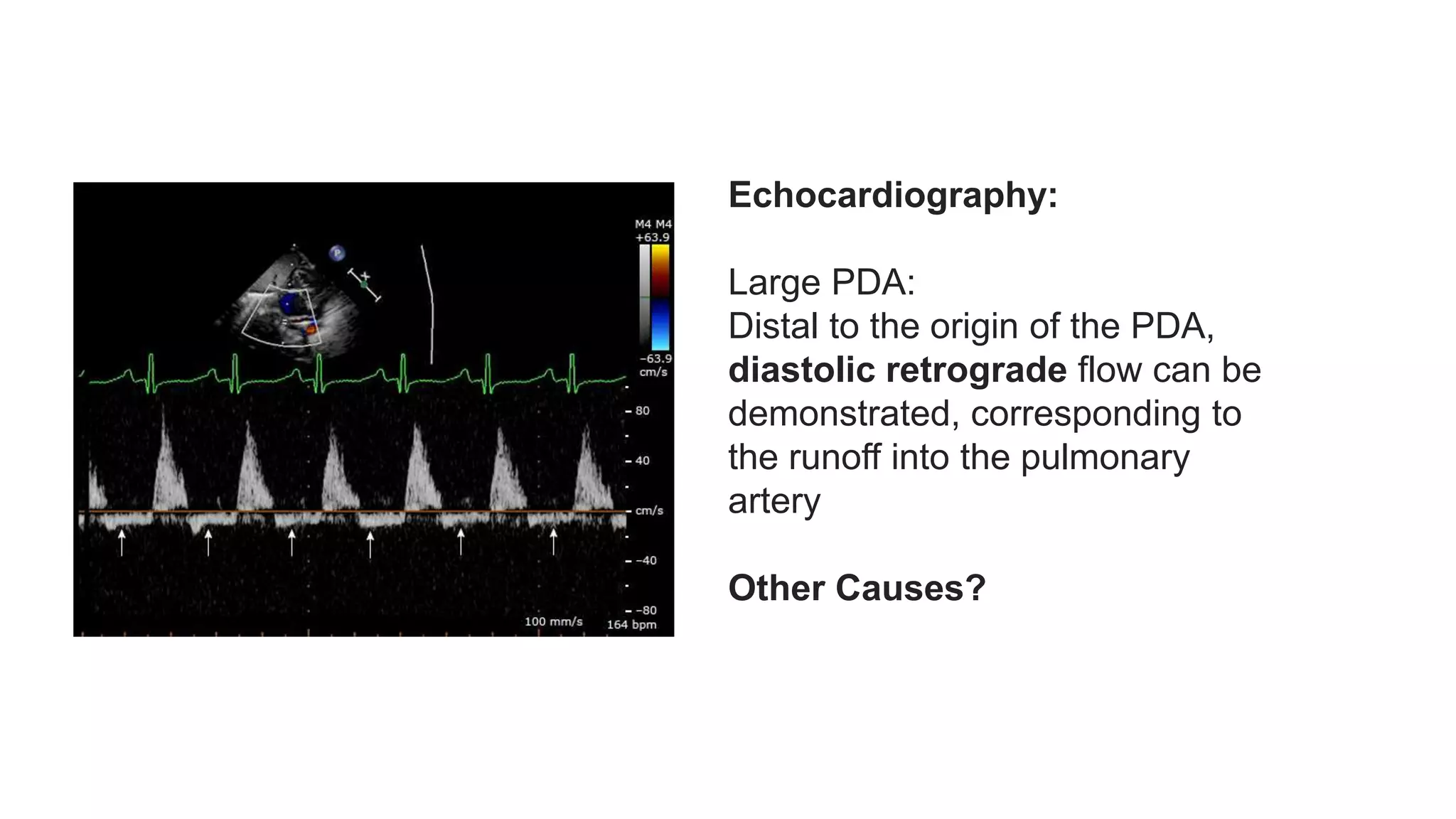 Patent Ductus Arteriosus (PDA) Echocardiographic Assessment Anatomy