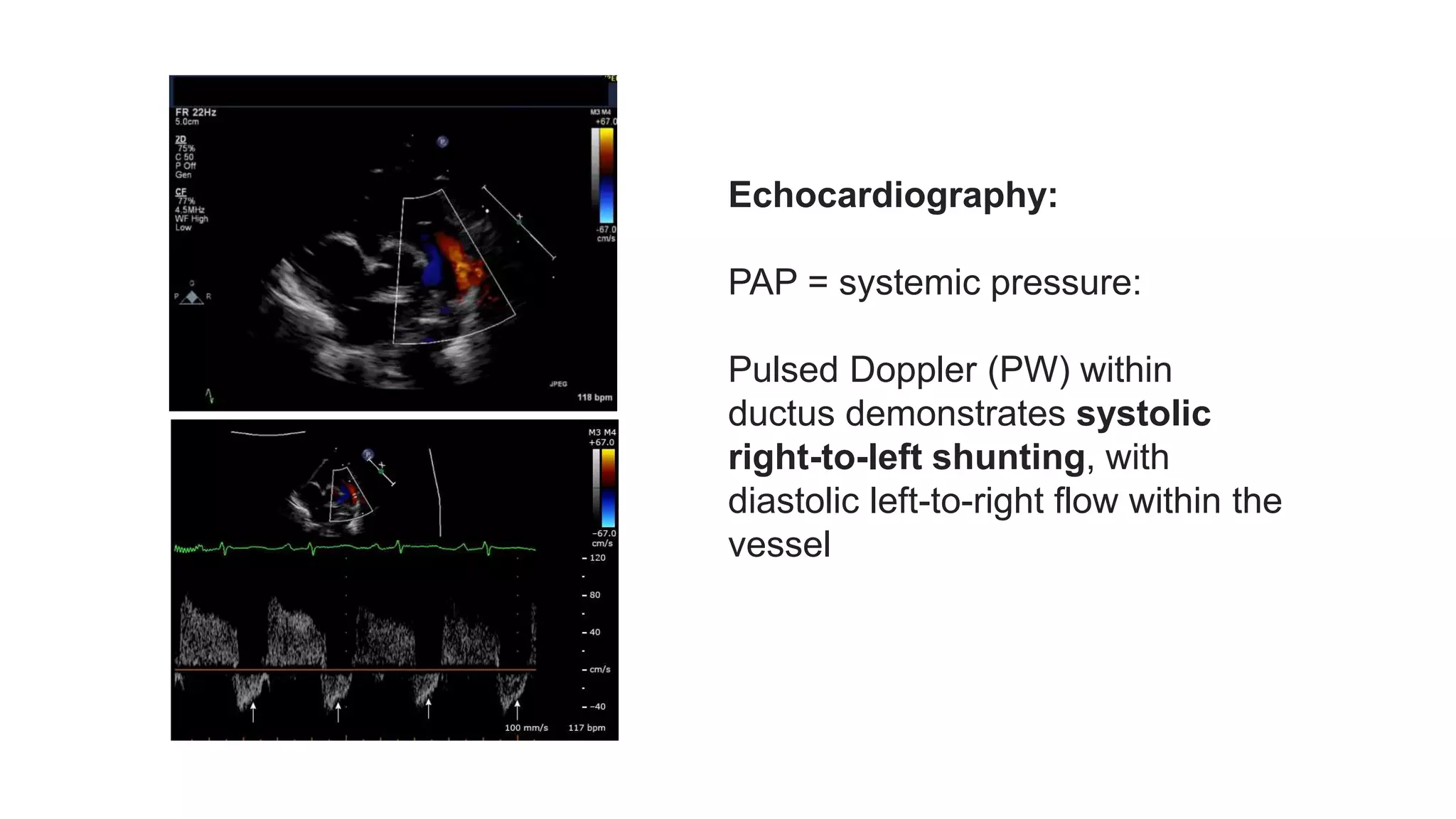 Patent Ductus Arteriosus (PDA) Echocardiographic Assessment Anatomy