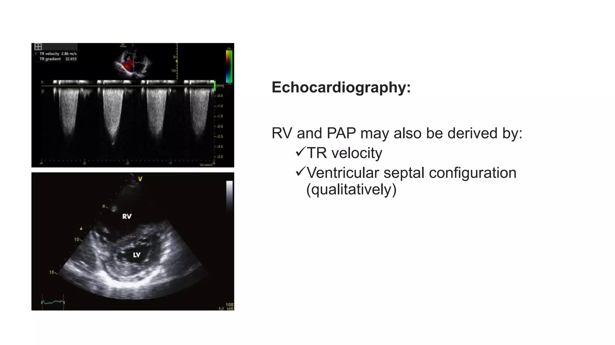 Patent Ductus Arteriosus (PDA) Echocardiographic Assessment Anatomy