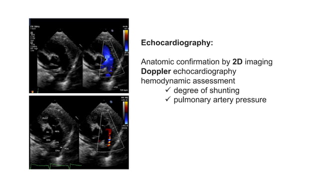 Patent Ductus Arteriosus (PDA) Echocardiographic Assessment: Anatomy ...