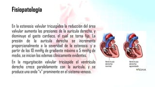 Cardiopatía valvular