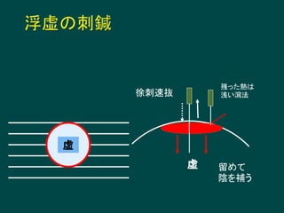虚
徐刺速抜
虚 留めて
陰を補う
残った熱は
浅い瀉法
 