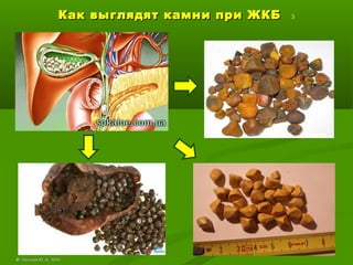 Как выглядят камни при ЖКБКак выглядят камни при ЖКБ 3
©© Лысиков Ю..А., 2015Лысиков Ю..А., 2015
 