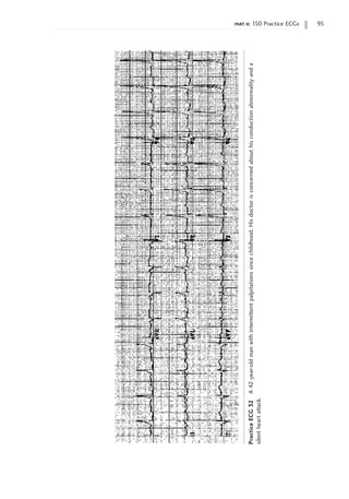 part ii: 150 Practice ECGs 95
Practice
ECG
32
A
42-year-old
man
with
intermittent
palpitations
since
childhood.
His
doctor
is
concerned
about
his
conduction
abnormality
and
a
silent
heart
attack.
 