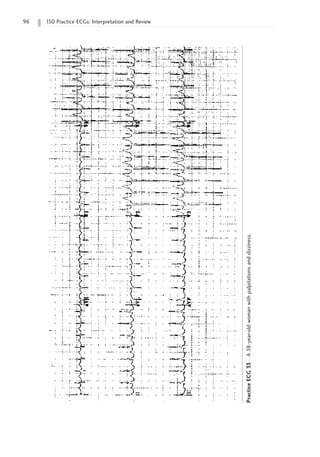 96 150 Practice ECGs: Interpretation and Review
Practice
ECG
33
A
38-year-old
woman
with
palpitations
and
dizziness.
 