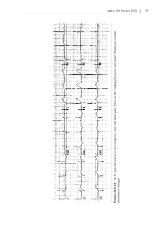 part ii: 150 Practice ECGs 97
Practice
ECG
34
An
81-year-old
woman
in
the
emergency
room
with
chest
pain.
What
are
the
treating
physician’s
next
steps?
Would
you
consider
thrombolytic
therapy?
 