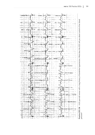 part ii: 150 Practice ECGs 99
Practice
ECG
36
A
65-year-old
woman
with
a
long
history
of
borderline
hypertension.
What
does
this
ECG
tell
you
about
control
of
her
blood
pressure?
 