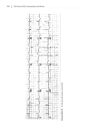 100 150 Practice ECGs: Interpretation and Review
Practice
ECG
37
An
86-year-old
woman,
annual
ECG.
 