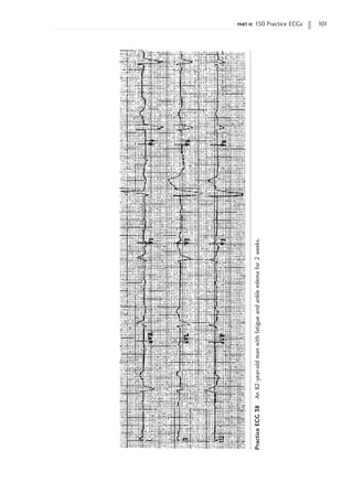 part ii: 150 Practice ECGs 101
Practice
ECG
38
An
82-year-old
man
with
fatigue
and
ankle
edema
for
2
weeks.
 