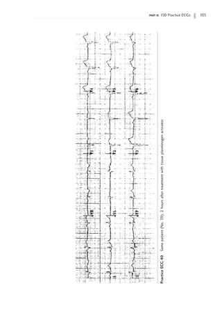 part ii: 150 Practice ECGs 103
Practice
ECG
40
Same
patient
(No.
39),
2
hours
after
treatment
with
tissue
plasminogen
activator.
 