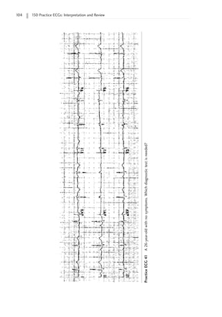 104 150 Practice ECGs: Interpretation and Review
Practice
ECG
41
A
26-year-old
with
no
symptoms.
Which
diagnostic
test
is
needed?
 