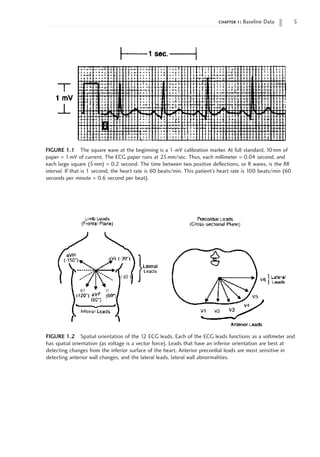 chapter 1: Baseline Data 
FIGURE 1.1 The square wave at the beginning is a 1-mV calibration marker. At full standard, 10mm of
paper = 1 mV of current. The ECG paper runs at 25mm/sec. Thus, each millimeter = 0.04 second, and
each large square (5mm) = 0.2 second. The time between two positive deflections, or R waves, is the RR
interval. If that is 1 second, the heart rate is 60 beats/min. This patient’s heart rate is 100 beats/min (60
seconds per minute ∏ 0.6 second per beat).
FIGURE 1.2 Spatial orientation of the 12 ECG leads. Each of the ECG leads functions as a voltmeter and
has spatial orientation (as voltage is a vector force). Leads that have an inferior orientation are best at
detecting changes from the inferior surface of the heart. Anterior precordial leads are most sensitive in
detecting anterior wall changes, and the lateral leads, lateral wall abnormalities.
 