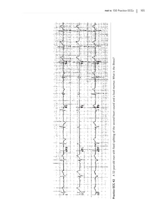 part ii: 150 Practice ECGs 105
Practice
ECG
42
A
32-year-old
man
with
fixed
splitting
of
the
second
heart
sound
and
a
loud
murmur.
What
is
the
illness?
 